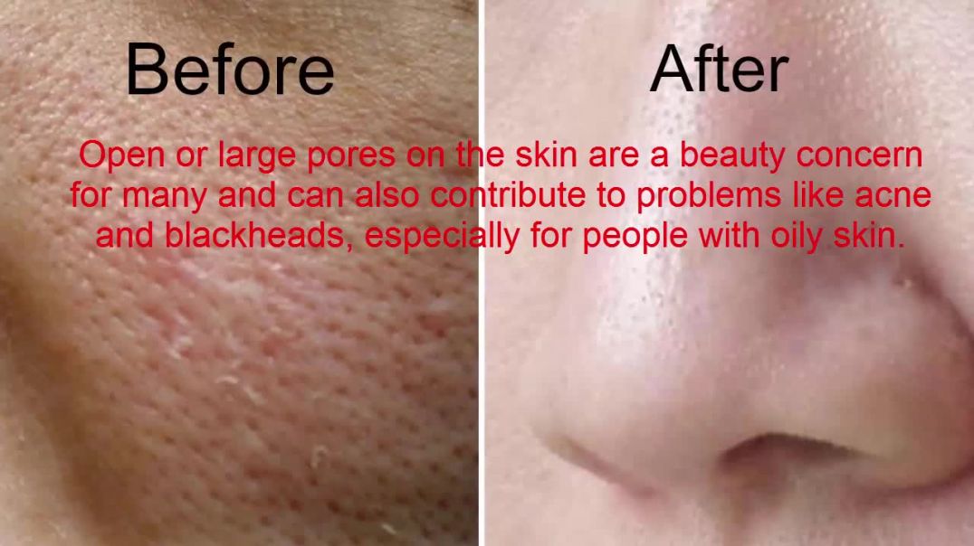 Get Rid Of Large Pores In 3 Days _ Get Smooth, Fairer And Tighter Skin