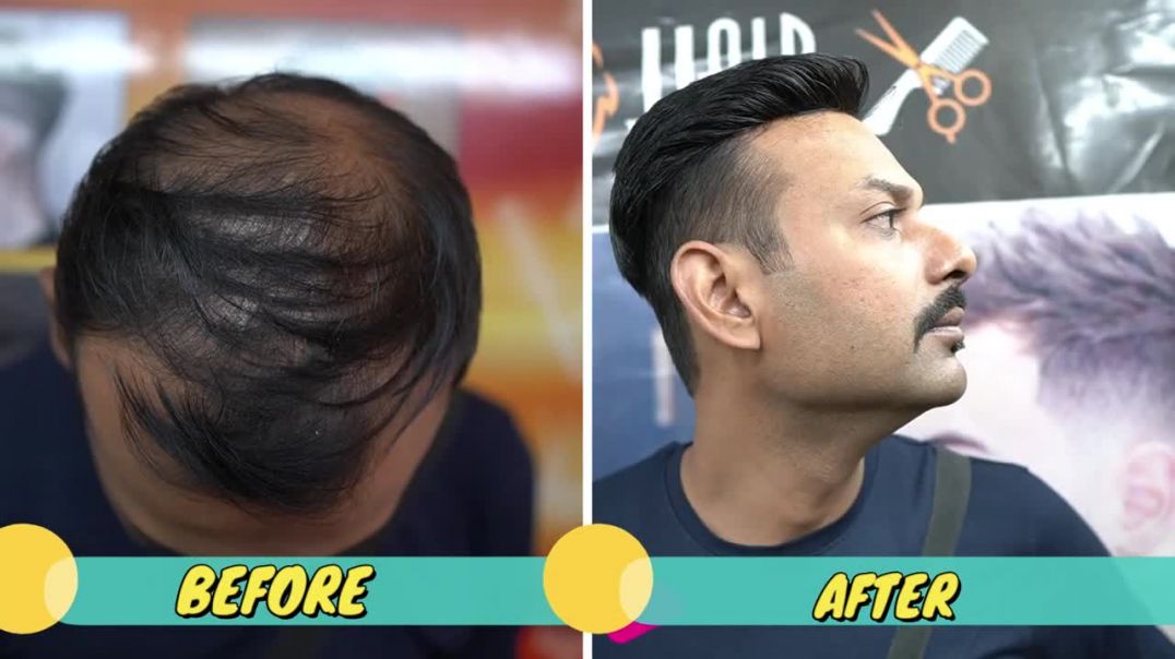 Non_Surgical Hair Replacement System for Men change your hair In less then 1 hour