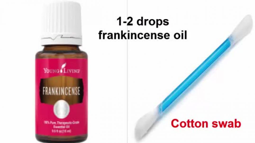 Essential Oils For Pimples